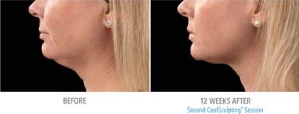 CoolSculpt Mini before and after for tough to treat areas