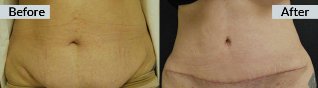 42 year old abdominoplasty/tummy tuck