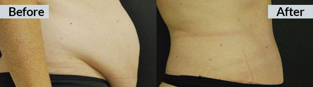 34 year old abdominoplasty/tummy tuck