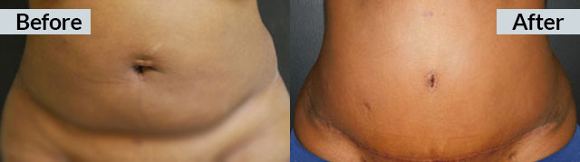 33 year old tummy tuck with liposuction